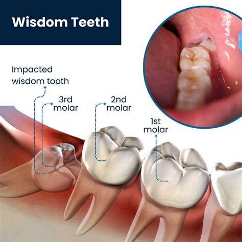 Future directions in wisdom teeth care