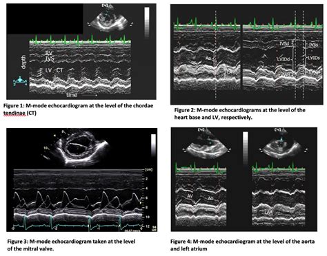Future of Cardioechogram