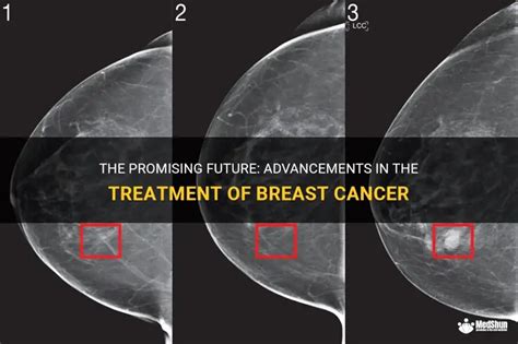 Future Perspectives on Breast Cancer Treatment