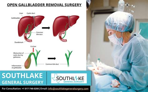 Gallbladder Surgery Overview