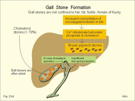 gallstone formation