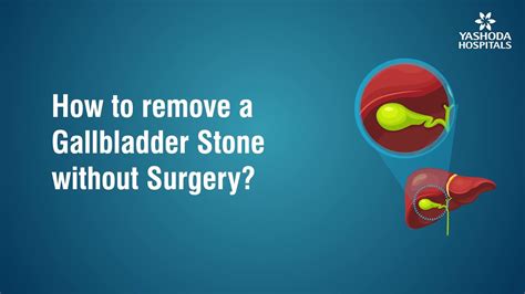 gallstone removal