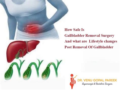 Gallstone Surgery Recovery and Lifestyle Changes