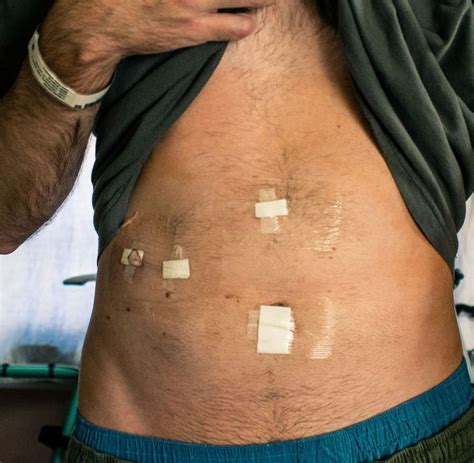 Gallstone Surgery Recovery Time