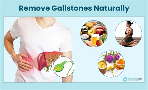 gallstone treatment