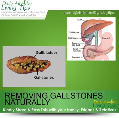 Gallstones Alternative Therapies