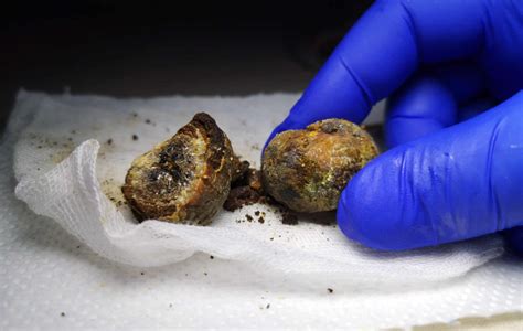 Gallstones operation overview
