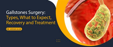 Gallstones Treatment