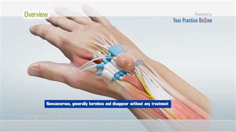 ganglion cyst surgery overview