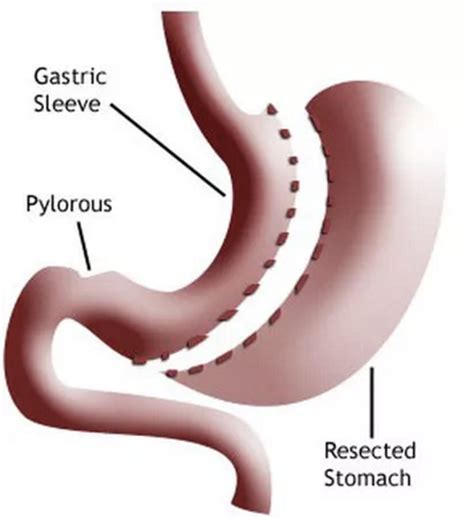 Gastric sleeve procedure illustration