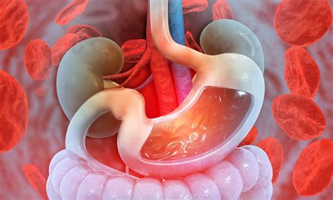 Gastrointestinal bleeding illustration