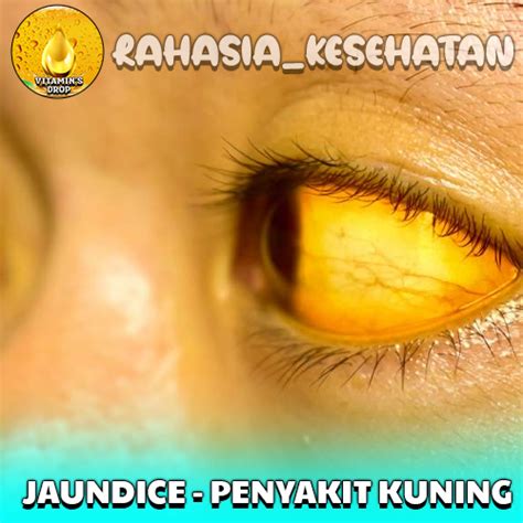 Gejala Bilirubin