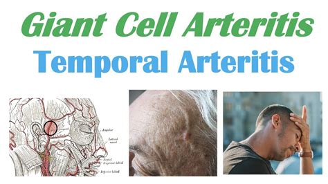 Giant Cell Arteritis Diagnosis