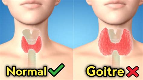 Goiter Disease