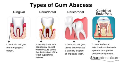 gum abscess causes