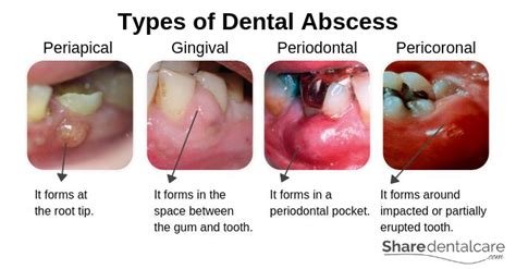 gum abscess complications