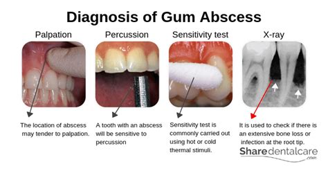 gum abscess conclusion