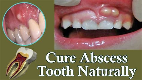gum abscess treatment outcomes
