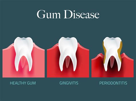 gum disease introduction