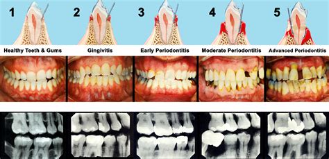 gum disease progression