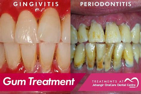 gum disease treatment