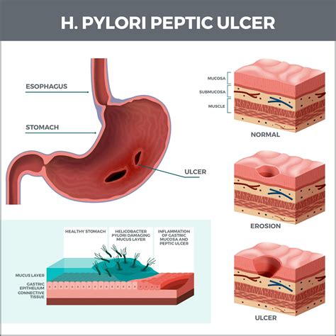 H. Pylori Infection Complications