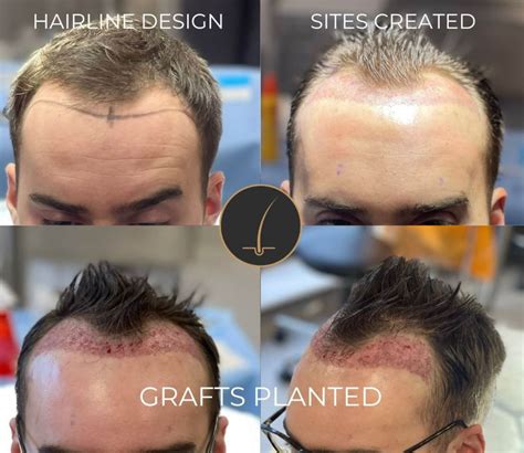 Hair Transplantation Costs and Financing