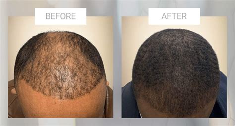 Hair Transplantation for Ethnic Hair