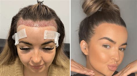 Hair Transplantation for Women