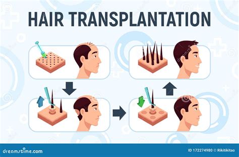 Hair Transplantation Procedures