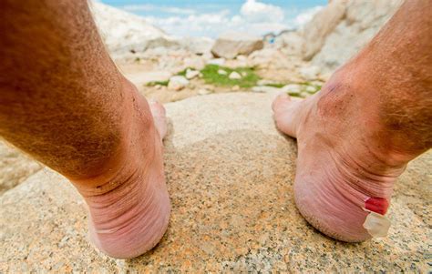 Healing Blisters Quickly