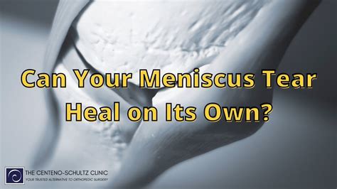 Healing Meniscus Tear