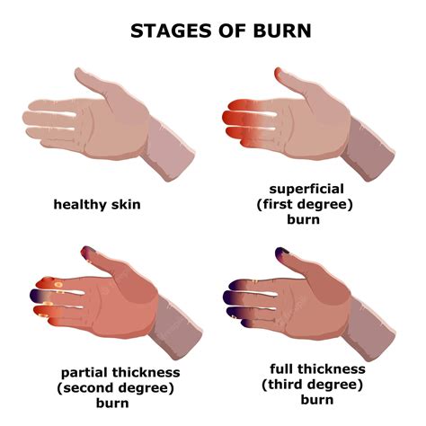 healing stages of 2nd degree burns