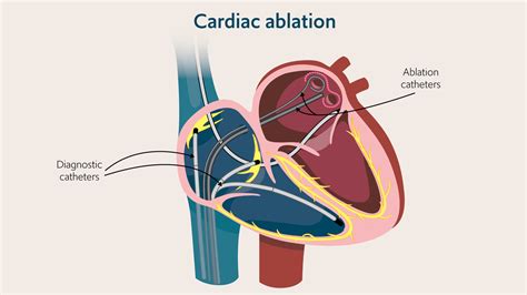 heart ablation procedure