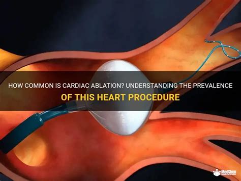 heart ablation conclusion