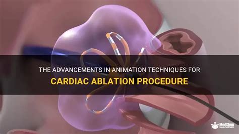 heart ablation procedure steps