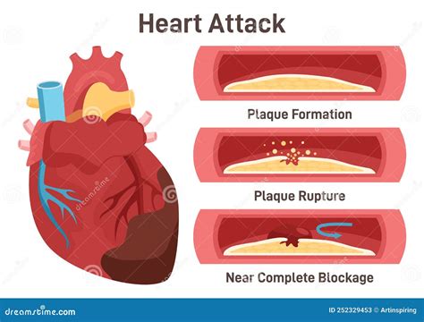 Heart Attack Mechanism