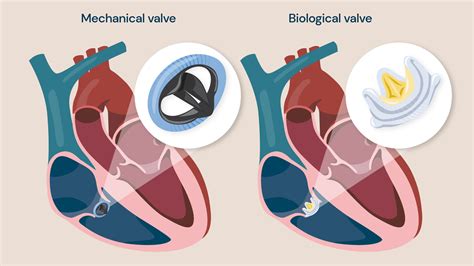 Heart Valve Repair Options