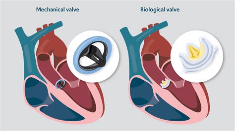 Heart Valve Replacement Surgery