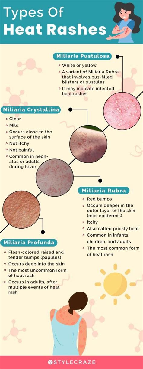Heat Rash Causes