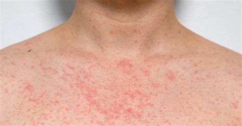 Heat Rash Conclusion
