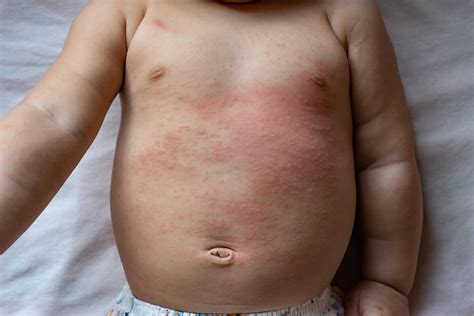 heat rash newborn