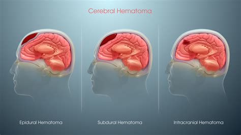 Types of Hematoma