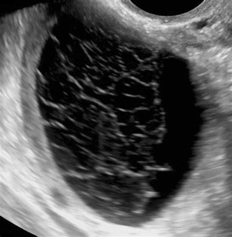 Hemorrhagic Cyst Overview