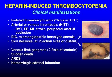 Heparin-induced thrombocytopenia