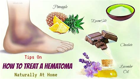 Herbal Remedies for Hematomas