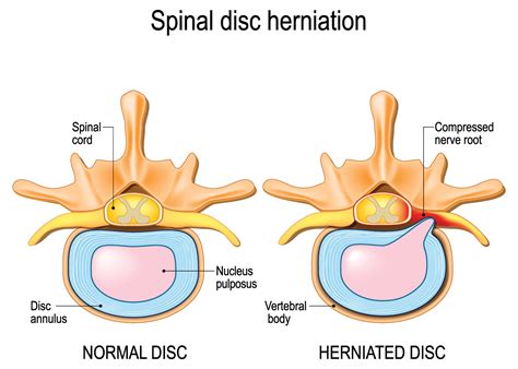 herniated disc overview