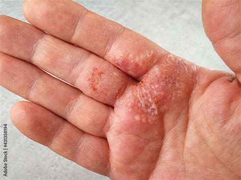 Herpes on Hand Causes