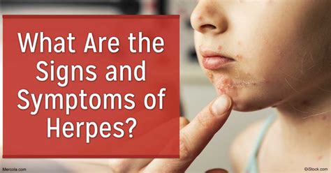 Herpes under lip symptoms