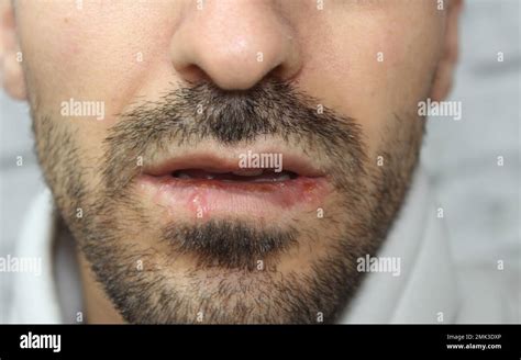 Herpes under lip causes